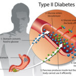 Diabetes and How To Beat It